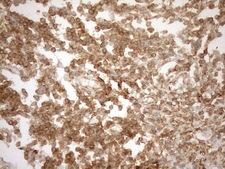 POU2AF1 / BOB1 Antibody - Immunohistochemical staining of paraffin-embedded Carcinoma of Human pancreas tissue using anti-POU2AF1 mouse monoclonal antibody. (Heat-induced epitope retrieval by 1mM EDTA in 10mM Tris buffer. (pH8.5) at 120°C for 3 min. (1:150)