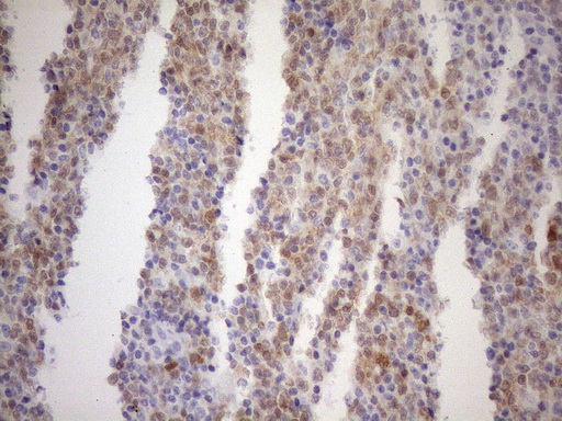 POU2AF1 / BOB1 Antibody - Immunohistochemical staining of paraffin-embedded Human lymphoma tissue using anti-POU2AF1 mouse monoclonal antibody. (Heat-induced epitope retrieval by 1mM EDTA in 10mM Tris buffer. (pH8.5) at 120°C for 3 min. (1:150)