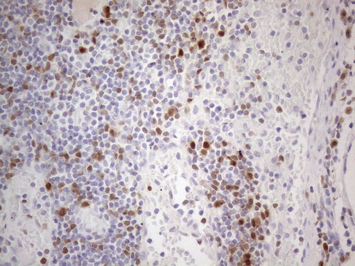 POU2AF1 / BOB1 Antibody - Immunohistochemical staining of paraffin-embedded Carcinoma of Human thyroid tissue using anti-POU2AF1 mouse monoclonal antibody. (Heat-induced epitope retrieval by 1mM EDTA in 10mM Tris buffer. (pH8.5) at 120°C for 3 min. (1:150) Dilution: 1:150