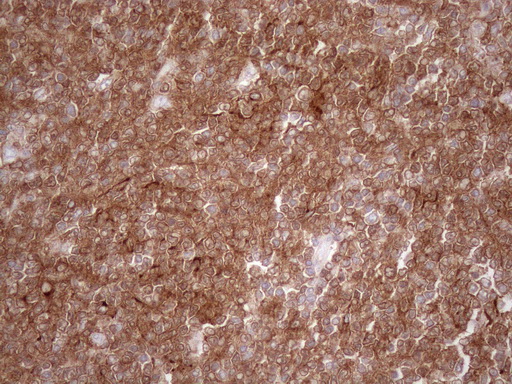 POU2AF1 / BOB1 Antibody - Immunohistochemical staining of paraffin-embedded Human lymphoma tissue using anti-POU2AF1 mouse monoclonal antibody at 1:150. (Heat-induced epitope retrieval by 1mM EDTA in 10mM Tris buffer. (pH8.5) at 120°C for 3 min. (1:150)