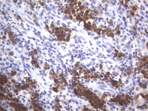 POU2AF1 / BOB1 Antibody - Immunohistochemical staining of paraffin-embedded human lymphoma tissue using anti-POU2AF1 mouse monoclonal antibody. HIER pretreatment was done with 1mM EDTA in 10mM Tris buffer. (pH8.0) at 120°C for 2.5 minutes.was diluted 1:250 and detection was done with HRP secondary and DAB chromogen. Strong nuclear, cytoplasmic, and membraneous staining tumor cells.