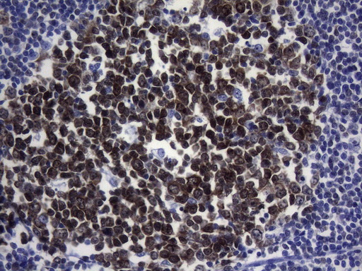 POU2AF1 / BOB1 Antibody - Immunohistochemical staining of paraffin-embedded Human tonsil within the normal limits using anti-POU2AF1 mouse monoclonal antibody. HIER pretreatment was done with 1mM EDTA in 10mM Tris buffer. (pH8.0) at 120°C for 2.5 minutes.was diluted 1:250 and detection was done with HRP secondary and DAB chromogen. Strong nuclear, cytoplasmic, and membraneous staining germinal cells of the tonsil.