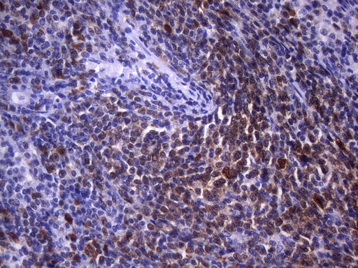 POU2AF1 / BOB1 Antibody - Immunohistochemical staining of paraffin-embeddedhuman lymphoma tissue using anti-POU2AF1 mouse monoclonal antibody. HIER pretreatment was done with 1mM EDTA in 10mM Tris buffer. (pH8.0) at 120°C for 2.5 minutes.was diluted 1:100 and detection was done with HRP secondary and DAB chromogen. Strong nuclear, cytoplasmic, and membraneous staining tumor cells.