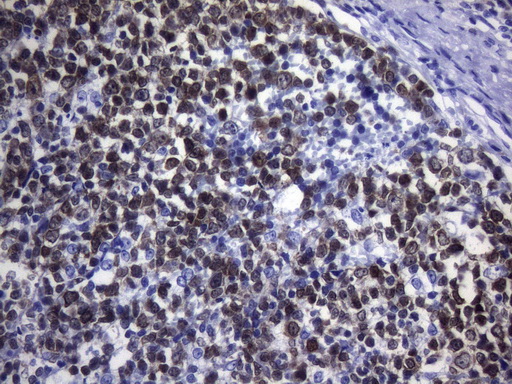 POU2AF1 / BOB1 Antibody - Immunohistochemical staining of paraffin-embedded Human tonsil within the normal limits using anti-POU2AF1 mouse monoclonal antibody. HIER pretreatment was done with 1mM EDTA in 10mM Tris buffer. (pH8.0) at 120°C for 2.5 minutes.was diluted 1:100 and detection was done with HRP secondary and DAB chromogen. Strong nuclear, cytoplasmic, and membraneous staining germinal cells of the tonsil.