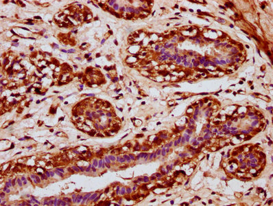 POU3F4 Antibody - Immunohistochemistry Dilution at 1:200 and staining in paraffin-embedded human breast cancer performed on a Leica BondTM system. After dewaxing and hydration, antigen retrieval was mediated by high pressure in a citrate buffer (pH 6.0). Section was blocked with 10% normal Goat serum 30min at RT. Then primary antibody (1% BSA) was incubated at 4°C overnight. The primary is detected by a biotinylated Secondary antibody and visualized using an HRP conjugated SP system.