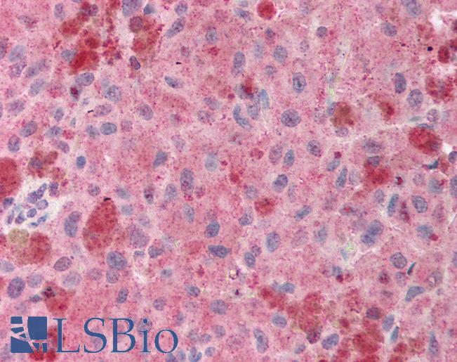POU5F1 / OCT4 Antibody - Anti-POU5F1 / OCT4 antibody IHC of human melanoma. Immunohistochemistry of formalin-fixed, paraffin-embedded tissue after heat-induced antigen retrieval. Antibody concentration 5 ug/ml.  This image was taken for the unconjugated form of this product. Other forms have not been tested.