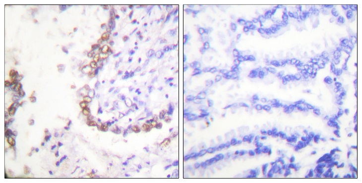POU5F1 / OCT4 Antibody - Immunohistochemistry analysis of paraffin-embedded human lung carcinoma tissue, using OCT3 Antibody. The picture on the right is blocked with the synthesized peptide.