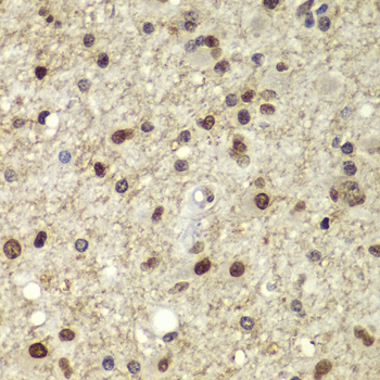 POU5F1 / OCT4 Antibody - Immunohistochemistry of paraffin-embedded human brain cancer tissue.