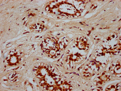 POU5F1B Antibody - Immunohistochemistry Dilution at 1:300 and staining in paraffin-embedded human breast cancer performed on a Leica BondTM system. After dewaxing and hydration, antigen retrieval was mediated by high pressure in a citrate buffer (pH 6.0). Section was blocked with 10% normal Goat serum 30min at RT. Then primary antibody (1% BSA) was incubated at 4°C overnight. The primary is detected by a biotinylated Secondary antibody and visualized using an HRP conjugated SP system.