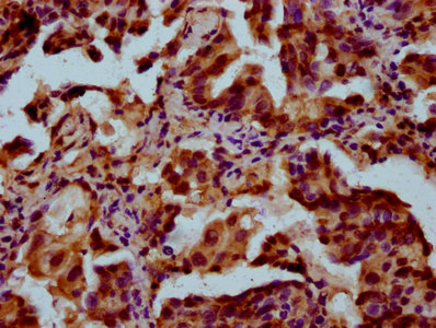 POU5F1B Antibody - Immunohistochemistry Dilution at 1:300 and staining in paraffin-embedded human lung cancer performed on a Leica BondTM system. After dewaxing and hydration, antigen retrieval was mediated by high pressure in a citrate buffer (pH 6.0). Section was blocked with 10% normal Goat serum 30min at RT. Then primary antibody (1% BSA) was incubated at 4°C overnight. The primary is detected by a biotinylated Secondary antibody and visualized using an HRP conjugated SP system.