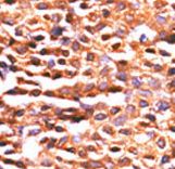 PP2Ac / PPP2CA Antibody - Formalin-fixed and paraffin-embedded human cancer tissue reacted with the primary antibody, which was peroxidase-conjugated to the secondary antibody, followed by DAB staining. This data demonstrates the use of this antibody for immunohistochemistry; clinical relevance has not been evaluated. BC = breast carcinoma; HC = hepatocarcinoma.