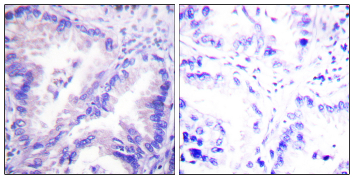 PP2Ac / PPP2CA Antibody - Immunohistochemistry analysis of paraffin-embedded human lung carcinoma tissue, using PP2A-alpha Antibody. The picture on the right is blocked with the synthesized peptide.