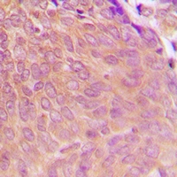PP2Ac / PPP2CA Antibody - Immunohistochemical analysis of PPP2CA staining in human breast cancer formalin fixed paraffin embedded tissue section. The section was pre-treated using heat mediated antigen retrieval with sodium citrate buffer (pH 6.0). The section was then incubated with the antibody at room temperature and detected using an HRP polymer system. DAB was used as the chromogen. The section was then counterstained with hematoxylin and mounted with DPX.