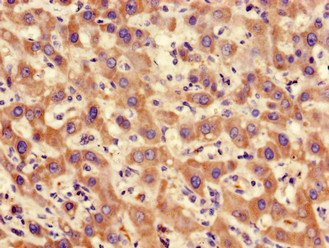 PP2Ac / PPP2CA Antibody - Immunohistochemistry of paraffin-embedded human liver cancer using PPP2CA Antibody at dilution of 1:100