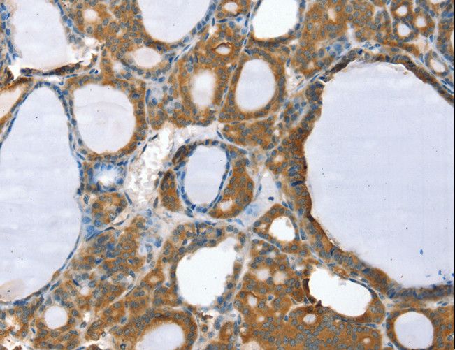 PP2Ac / PPP2CA Antibody - Immunohistochemistry of paraffin-embedded Human thyroid cancer using PPP2CA Polyclonal Antibody at dilution of 1:35.