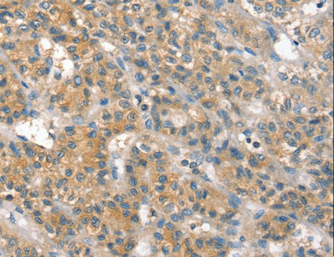 PP2Ac / PPP2CA Antibody - Immunohistochemistry of paraffin-embedded Human liver cancer using PPP2CA Polyclonal Antibody at dilution of 1:35.