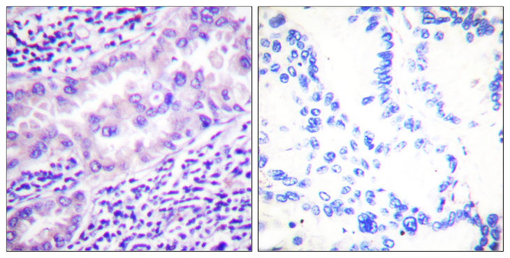PP2Ac / PPP2CA Antibody - Immunohistochemistry analysis of paraffin-embedded human lung carcinoma, using PP2A-alpha (Phospho-Tyr307) Antibody. The picture on the right is blocked with the phospho peptide.