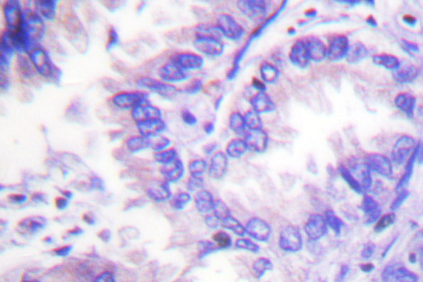PP2Ac / PPP2CA Antibody - IHC of PP2A- (T301) pAb in paraffin-embedded human lung carcinoma tissue.