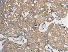 PP2CB / PPP2CB Antibody - Immunohistochemistry of paraffin-embedded Human breast cancer using PPP2CB Polyclonal Antibody at dilution of 1:50.