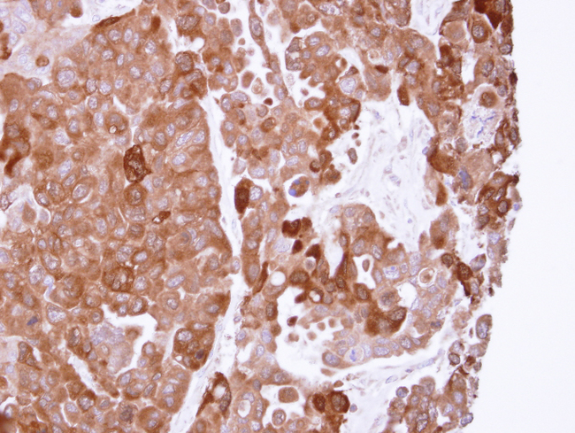 PPA1 Antibody - IHC of paraffin-embedded OVCAR3 xenograft using PPA1 antibody at 1:500 dilution.