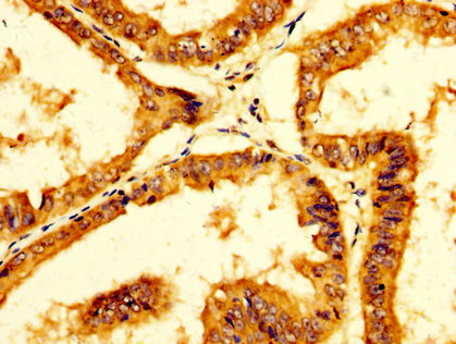 PPA1 Antibody - Immunohistochemistry image at a dilution of 1:200 and staining in paraffin-embedded human endometrial cancer performed on a Leica BondTM system. After dewaxing and hydration, antigen retrieval was mediated by high pressure in a citrate buffer (pH 6.0) . Section was blocked with 10% normal goat serum 30min at RT. Then primary antibody (1% BSA) was incubated at 4 °C overnight. The primary is detected by a biotinylated secondary antibody and visualized using an HRP conjugated SP system.