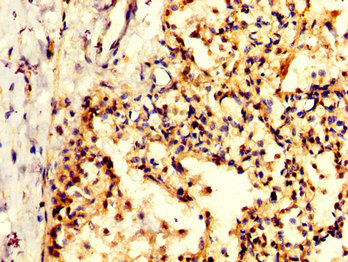 PPA1 Antibody - Immunohistochemistry image at a dilution of 1:200 and staining in paraffin-embedded human lung tissue performed on a Leica BondTM system. After dewaxing and hydration, antigen retrieval was mediated by high pressure in a citrate buffer (pH 6.0) . Section was blocked with 10% normal goat serum 30min at RT. Then primary antibody (1% BSA) was incubated at 4 °C overnight. The primary is detected by a biotinylated secondary antibody and visualized using an HRP conjugated SP system.