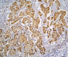 PPA1 Antibody - IHC staining of FFPE human breast cancer with PPA1 antibody at 1ug/ml. HIER: boil tissue sections in pH6, 10mM citrate buffer, for 10-20 min and allow to cool before testing.