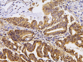 PPA1 Antibody - IHC staining of FFPE human intestinal cancer with PPA1 antibody at 1ug/ml. HIER: boil tissue sections in pH6, 10mM citrate buffer, for 10-20 min and allow to cool before testing.