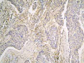 PPA1 Antibody - IHC staining of FFPE human lung cancer with PPA1 antibody at 1ug/ml. HIER: boil tissue sections in pH6, 10mM citrate buffer, for 10-20 min and allow to cool before testing.