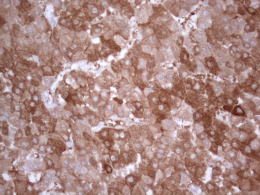 PPA2 Antibody - Immunohistochemical staining of paraffin-embedded Carcinoma of Human liver tissue using anti-PPA2 mouse monoclonal antibody. (Heat-induced epitope retrieval by 1mM EDTA in 10mM Tris buffer. (pH8.5) at 120°C for 3 min. (1:150)