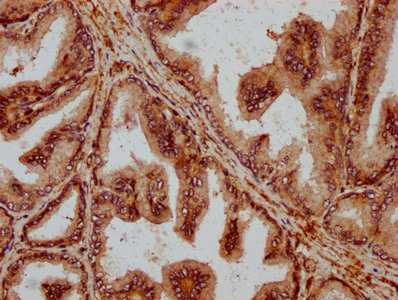 PPA2 Antibody - Immunohistochemistry Dilution at 1:200 and staining in paraffin-embedded human prostate tissue performed on a Leica BondTM system. After dewaxing and hydration, antigen retrieval was mediated by high pressure in a citrate buffer (pH 6.0). Section was blocked with 10% normal Goat serum 30min at RT. Then primary antibody (1% BSA) was incubated at 4°C overnight. The primary is detected by a biotinylated Secondary antibody and visualized using an HRP conjugated SP system.