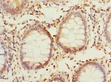 PPAP2C Antibody - Immunohistochemistry of paraffin-embedded human colon cancer using antibody at dilution of 1:100.