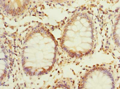 PPAP2C Antibody - Immunohistochemistry of paraffin-embedded human colon cancer using PLPP2 Antibody at dilution of 1:100