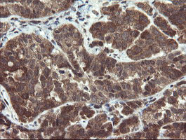 PPAT Antibody - IHC of paraffin-embedded Adenocarcinoma of Human ovary tissue using anti-PPAT mouse monoclonal antibody. (Heat-induced epitope retrieval by 10mM citric buffer, pH6.0, 120°C for 3min).
