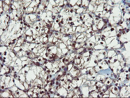 PPAT Antibody - IHC of paraffin-embedded Carcinoma of Human kidney tissue using anti-PPAT mouse monoclonal antibody. (Heat-induced epitope retrieval by 10mM citric buffer, pH6.0, 120°C for 3min).