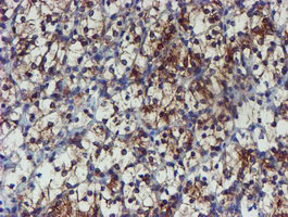 PPAT Antibody - IHC of paraffin-embedded Carcinoma of Human kidney tissue using anti-PPAT mouse monoclonal antibody. (Heat-induced epitope retrieval by 10mM citric buffer, pH6.0, 100C for 10min).