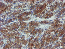PPAT Antibody - IHC of paraffin-embedded Carcinoma of Human liver tissue using anti-PPAT mouse monoclonal antibody. (Heat-induced epitope retrieval by 10mM citric buffer, pH6.0, 100C for 10min).
