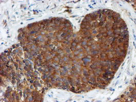 PPAT Antibody - IHC of paraffin-embedded Carcinoma of Human lung tissue using anti-PPAT mouse monoclonal antibody. (Heat-induced epitope retrieval by 10mM citric buffer, pH6.0, 100C for 10min).