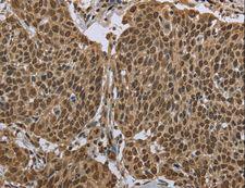 PPAT Antibody - Immunohistochemistry of paraffin-embedded Human cervical cancer using PPAT Polyclonal Antibody at dilution of 1:50.