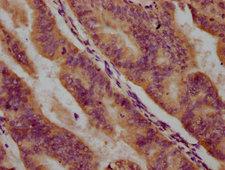 PPCDC Antibody - Immunohistochemistry Dilution at 1:500 and staining in paraffin-embedded human endometrial cancer performed on a Leica BondTM system. After dewaxing and hydration, antigen retrieval was mediated by high pressure in a citrate buffer (pH 6.0). Section was blocked with 10% normal Goat serum 30min at RT. Then primary antibody (1% BSA) was incubated at 4°C overnight. The primary is detected by a biotinylated Secondary antibody and visualized using an HRP conjugated SP system.