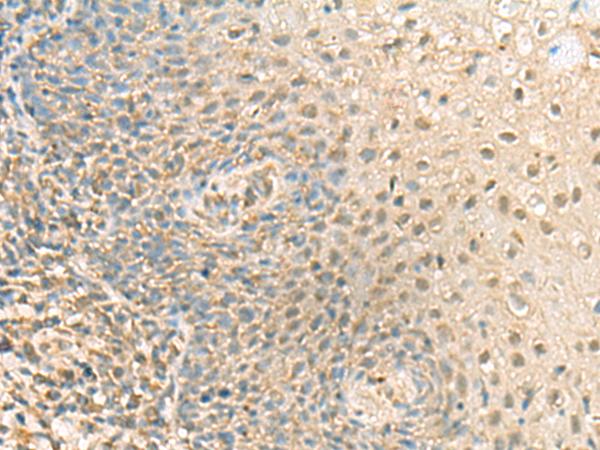 PPCDC Antibody - Immunohistochemistry of paraffin-embedded Human tonsil tissue  using PPCDC Polyclonal Antibody at dilution of 1:55(×200)