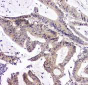 PPCS Antibody - IHC staining of FFPE human intestinal cancer with PPCS antibody at 1ug/ml. HIER: boil tissue sections in pH6, 10mM citrate buffer, for 10-20 min and allow to cool before testing.
