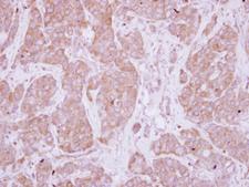 PPEF / PPEF1 Antibody - IHC of paraffin-embedded Breast ca, using PPEF1 antibody at 1:250 dilution.