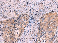 PPEF / PPEF1 Antibody - Immunohistochemistry of paraffin-embedded Human cervical cancer tissue  using PPEF1 Polyclonal Antibody at dilution of 1:100(×200)