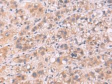 PPEF / PPEF1 Antibody - Immunohistochemistry of paraffin-embedded Human liver cancer tissue  using PPEF1 Polyclonal Antibody at dilution of 1:90(×200)