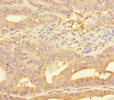 PPFIA1 / LIPRIN Antibody - Immunohistochemistry of paraffin-embedded human endometrial cancer at dilution of 1:100