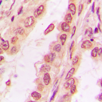PPHLN1 Antibody - Immunohistochemical analysis of PPHLN1 staining in human breast cancer formalin fixed paraffin embedded tissue section. The section was pre-treated using heat mediated antigen retrieval with sodium citrate buffer (pH 6.0). The section was then incubated with the antibody at room temperature and detected using an HRP conjugated compact polymer system. DAB was used as the chromogen. The section was then counterstained with hematoxylin and mounted with DPX.