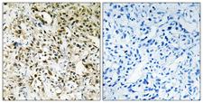 PPHLN1 Antibody - Peptide - + Immunohistochemistry analysis of paraffin-embedded human liver carcinoma tissue using PPHLN antibody.