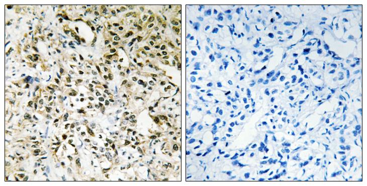 PPHLN1 Antibody - Peptide - + Immunohistochemistry analysis of paraffin-embedded human liver carcinoma tissue using PPHLN antibody.