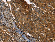 PPIA / Cyclophilin A Antibody - Immunohistochemistry of paraffin-embedded Human cervical cancer using PPIA Polyclonal Antibody at dilution of 1:35.